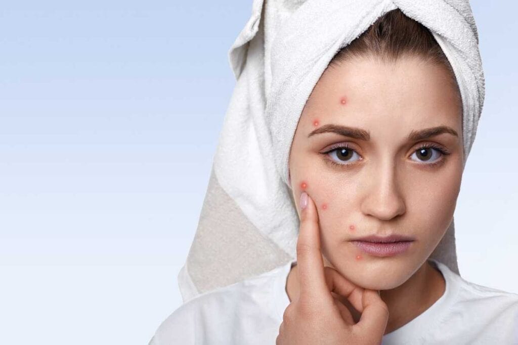 prophetic medicine for acne