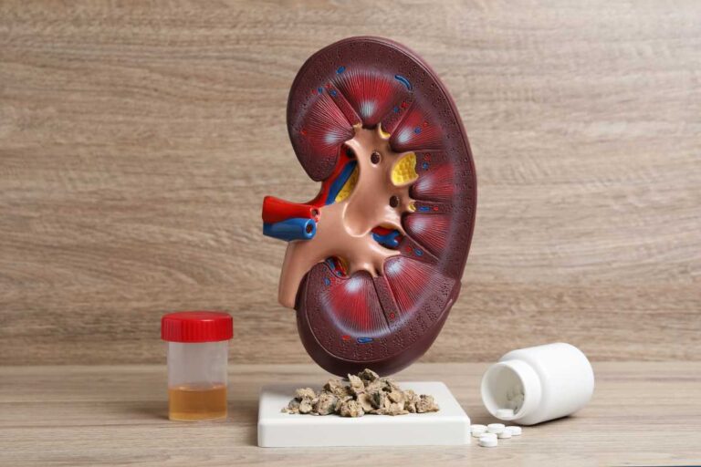 Prophetic Medicine for Kidney Stones: Natural Remedies